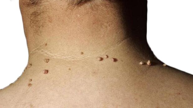 Papillomas in the neck - a consequence of the defeat of the virus