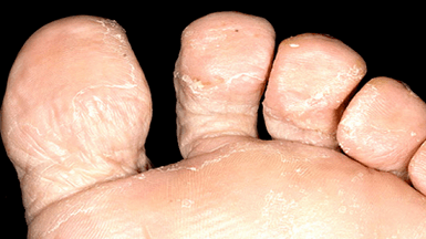 How to know the presence of a fungus between fingers