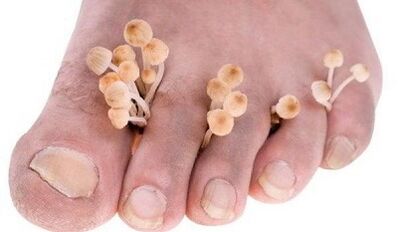 Reasons for developing fungi between fingers