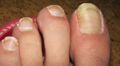 How manifested fungi on nails