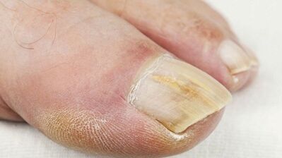 Initial stage of fungal development on nails