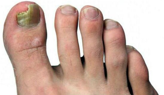 Pressing the nail