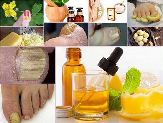 Folk remedies for the treatment of toenail fungus
