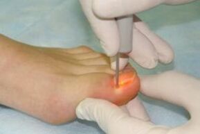 mechanical removal of the nail for fungal infection