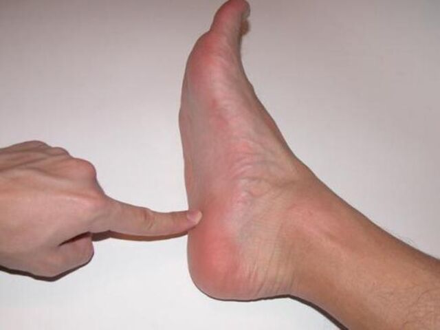 foot pain due to nail fungus