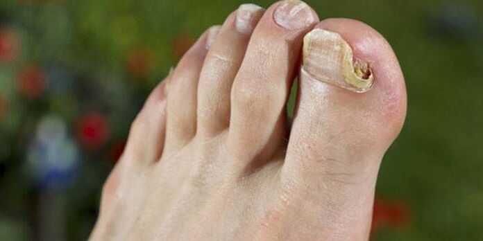 fungus on the nail of the thumb