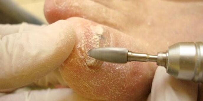 removing nail fungus