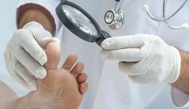 Diagnosis of fungi