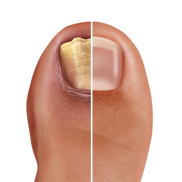 healthy and fungal nail