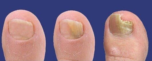 Development of toenail fungus