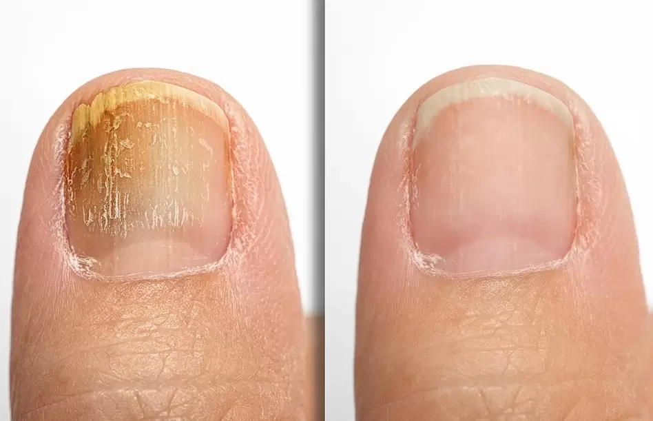 A nail with signs of fungus (left) and a healthy nail (right)