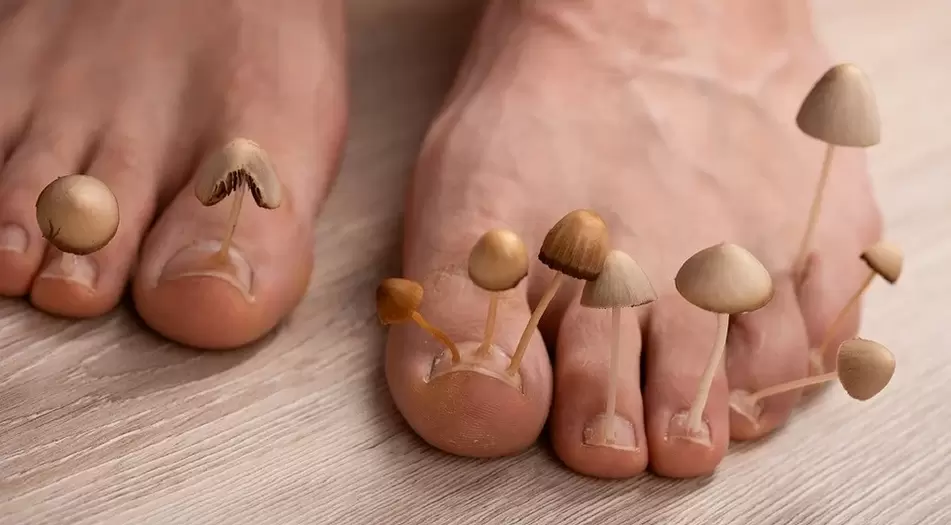 Fungal infection affecting the toenails