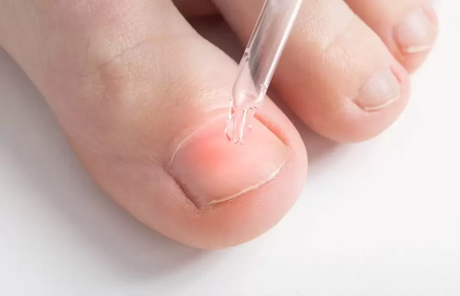 Treatment of onychomycosis with an antifungal solution