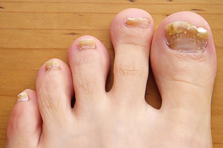 Symptoms of nail fungus