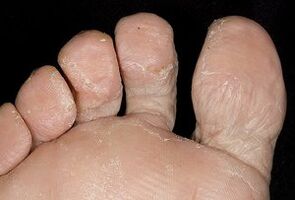 Foot skin with fungal infection