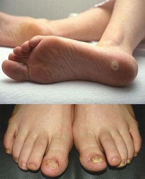 Manifestations of mycosis on the skin and toenails