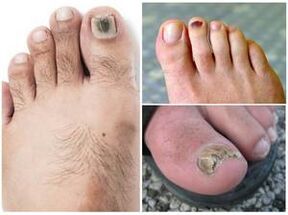 Signs of a fungal toenail infection