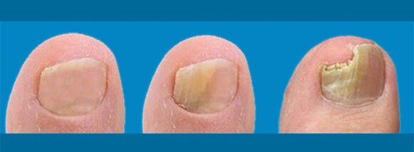 Development of onychomycosis - toenail fungus