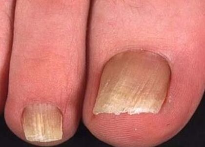 Nail fungus at the legs of the initial phase