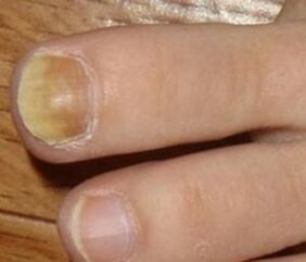 Symptoms of the initial phase of nail fungus